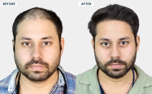 Brijraj Gautam hair transplant before and after results in Bhopal