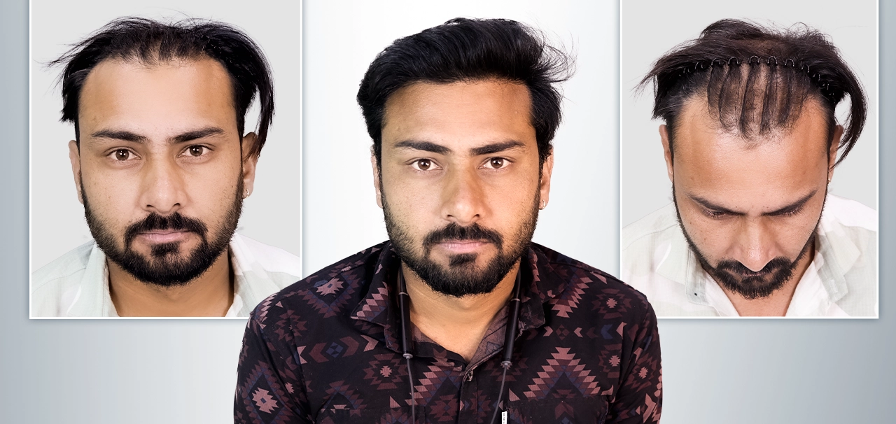 Deepak Meena hair transplant patient testimonial with natural results in Bhopal
