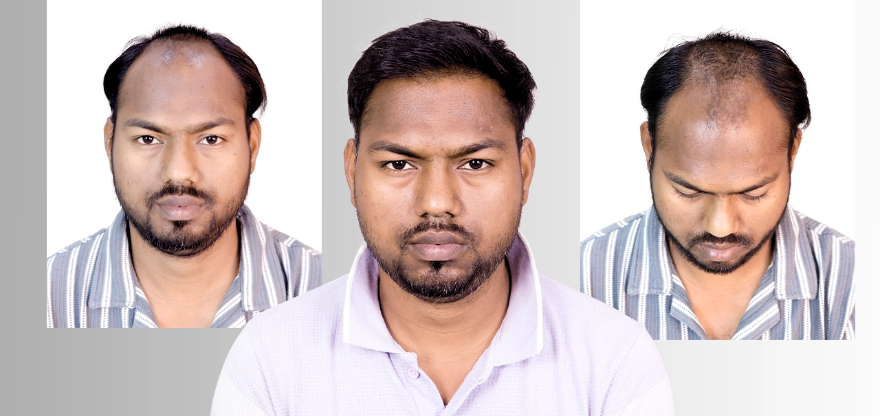 Golden Sharma hair transplant success story before after results in Bhopal