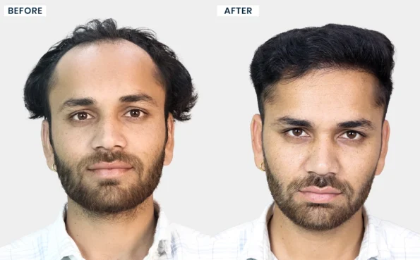 Golu Yadav hair transplant before after success story at HairFree HairGrow Bhopal