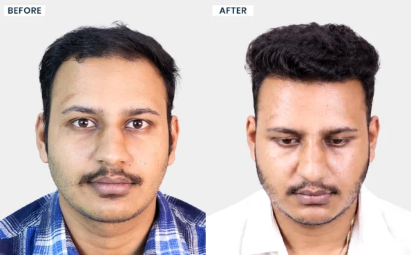 Jayank Sahu hair transplant before and after natural results in Bhopal