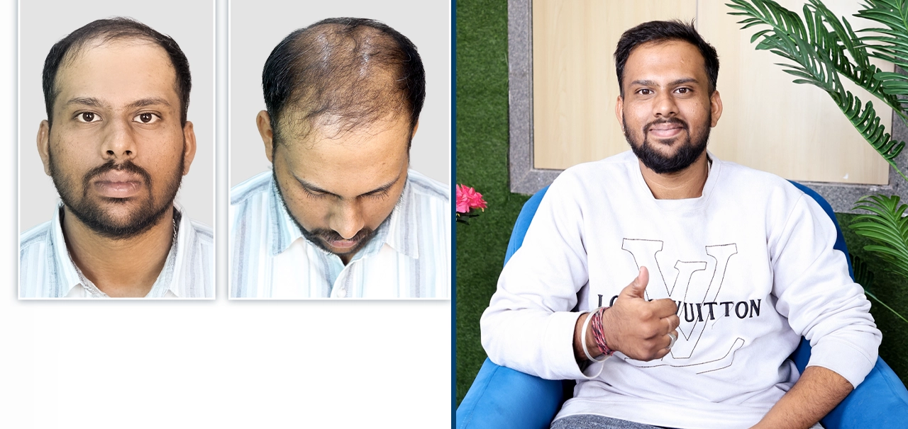 Manju Nath hair transplant patient review and transformation at HairFree HairGrow Bhopal