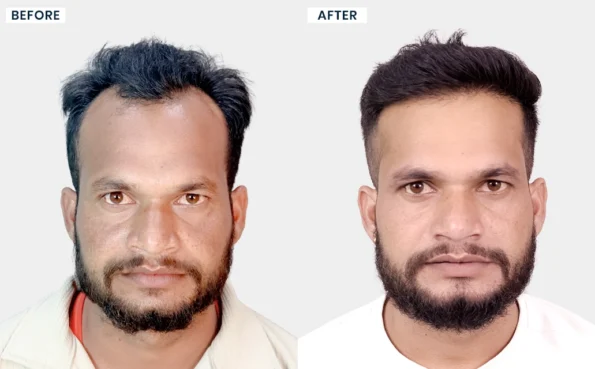 Rakesh Kumar Mehra hair transplant before after transformation in Bhopal