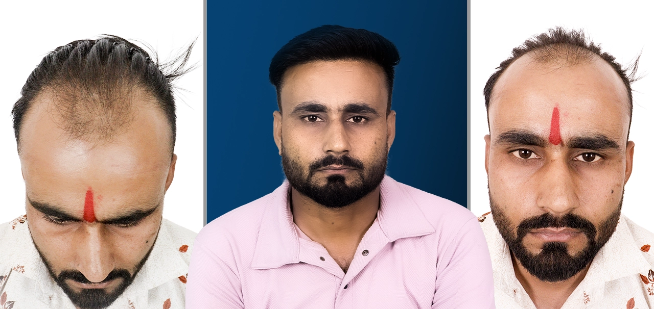 Ramit Vyas hair transplant review and before after results at HairFree HairGrow Clinic Bhopal